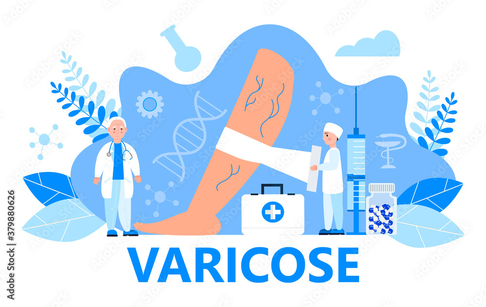 Varicose veins concept vector for medical website. Tiny surgeons, therapists treat vascular diseases, apply tight bandage. - obrazy, fototapety, plakaty 
