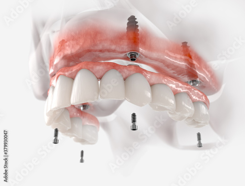 Maxillary prosthesis