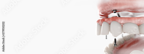 Maxillary prosthesis