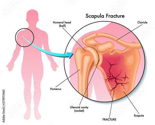 Medical illustration of a scapula fracture and its location in the human body, with annotations.