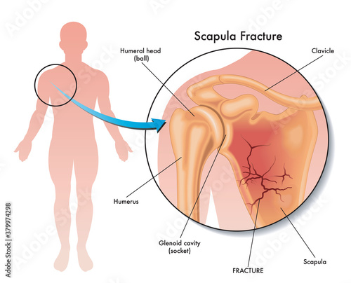 Medical illustration of a scapula fracture and its location in the human body, with annotations.