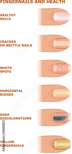 Problems with nails. Fingertips. Nail health. Types of problems affecting the extremities of the human body
