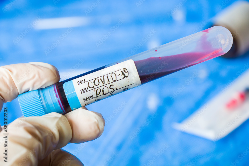Obraz premium Corona virus positive test samples. Diagnosis and laboratory. Studio shoot, white background.