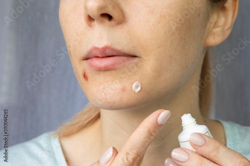  A girl applies a healing cream to acne on her face.