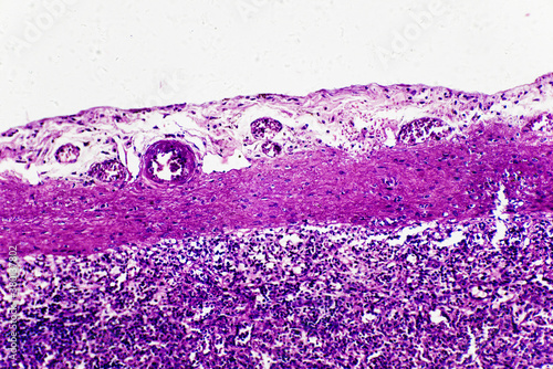 Central antery hyaline degene of human spleen photo