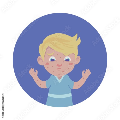 Kid with chickenpox