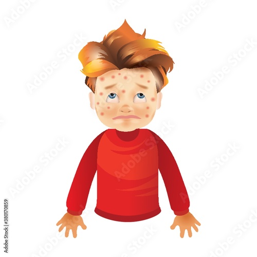 Boy with chickenpox