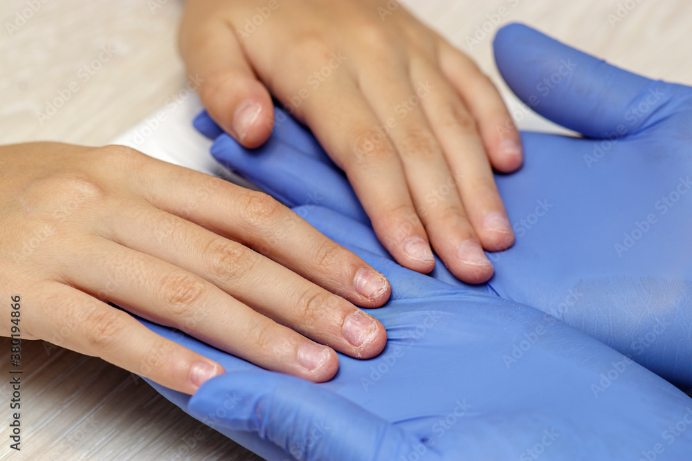 Fototapeta premium Child's hands with very short damaged nails. Hygienic medical manicure for children. 