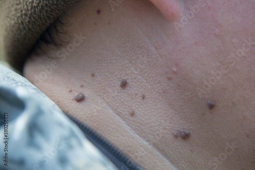 Papillomas on the human neck. Removal of papillomas. photo