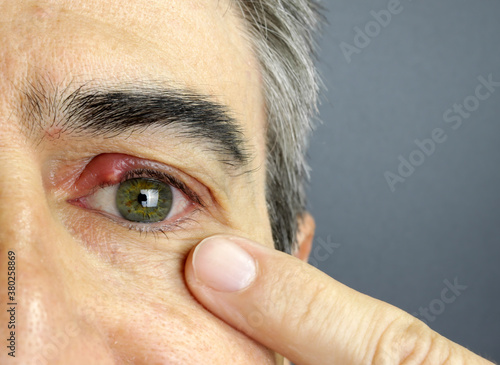 Close-up of a man eye stye. Ophthalmic hordeolum disease, chalazion photo