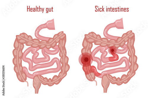 Human intestine. Healthy and diseased intestine, the digestive system. Vector illustration