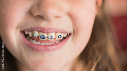 Close up of girl's (8-9) mouth with braces