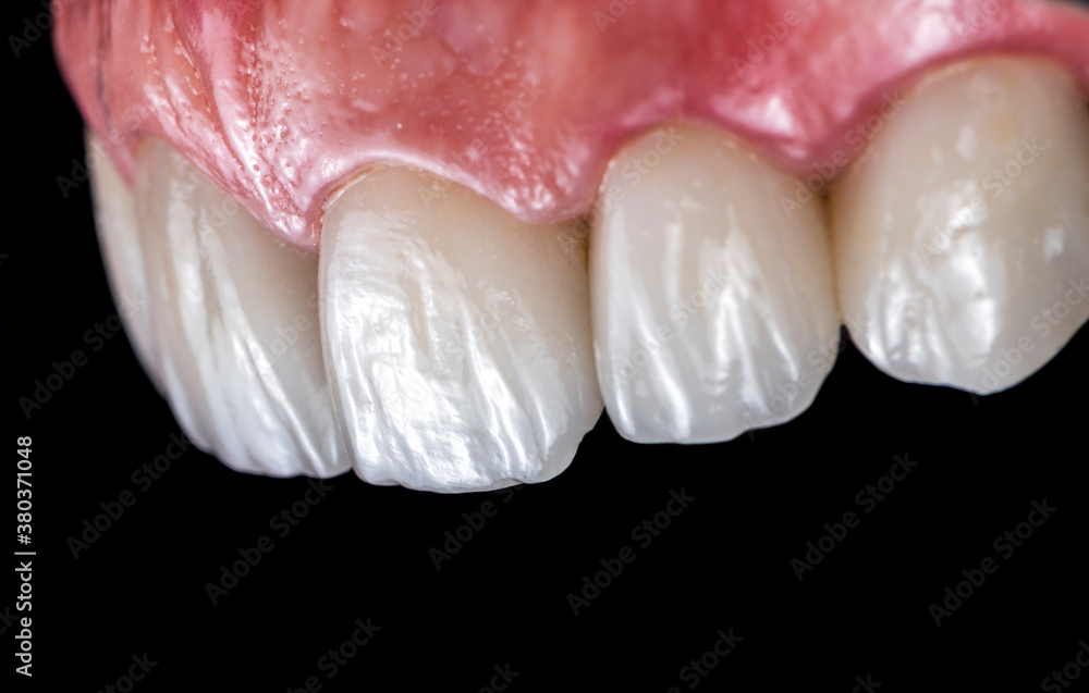 a2 color ress ceramic natural look veneers