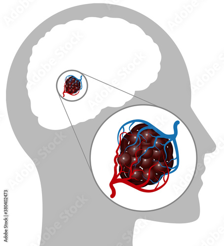 Cavernous Angioma is a blood vessel abnormality characterized by large, adjacent capillaries with little or no intervening brain. The blood flow through these vessels is slow. Magnetic resonance
