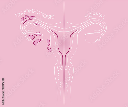 Illustration of endometriosis, endometrial tissue in the uterus, female disease, womens medicine photo