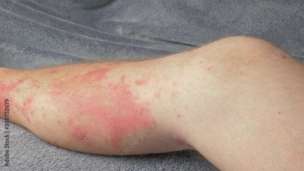 Skin rash covering lower leg. Poison sumac reaction resulting in itchy ...