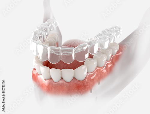 Transparent retainer fixed on lower jow.