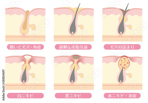 毛穴の状態とニキビのメカニズム