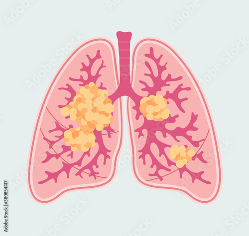 Lung cancer - vector patient-friendly scheme. Anatomical diagram in hand drawn style. Respiratory disease - Lung Carcinoma. Oncologic tumor and metastasis