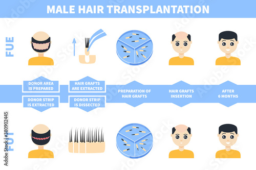 Male alopecia treatment with FUE and FUT methods. Follicular unit extraction versus follicular unit transplantation. Hair transplant stages. Medical infographics. Vector illustration.