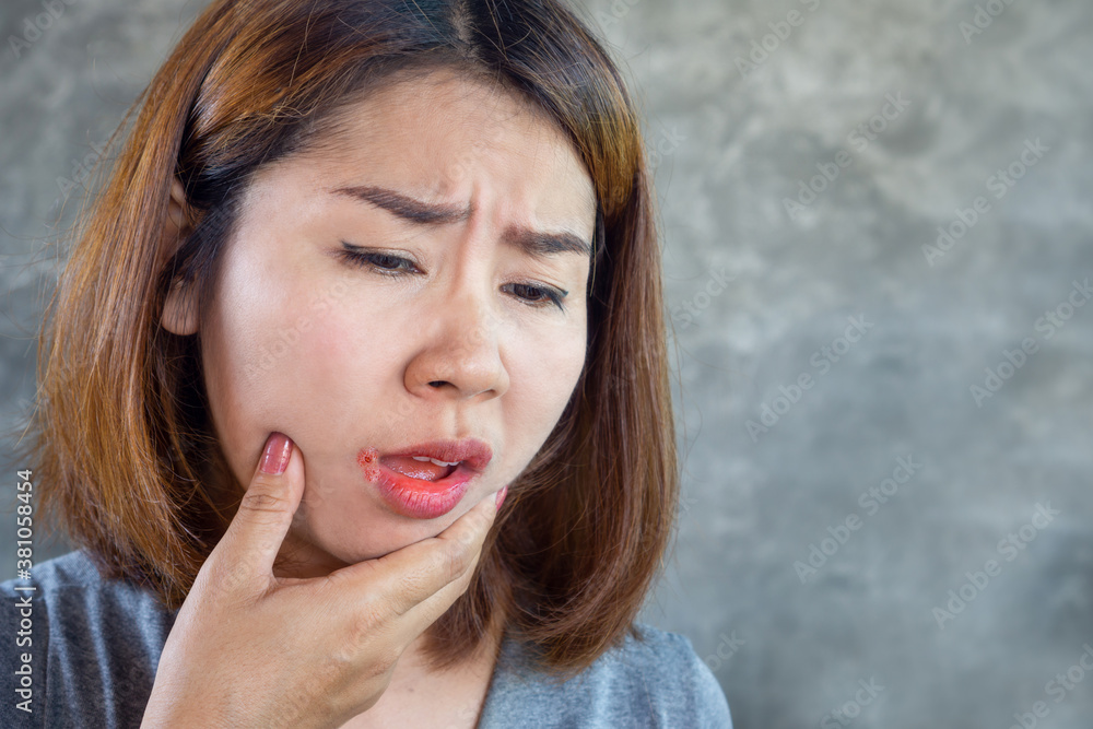 Asian woman having problem with mouth disease dry skin on corner of ...