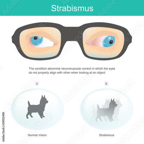 Strabismus. Meaning the condition abnormal neuromuscular control in which the eyes do not properly align with other when looking at an object..