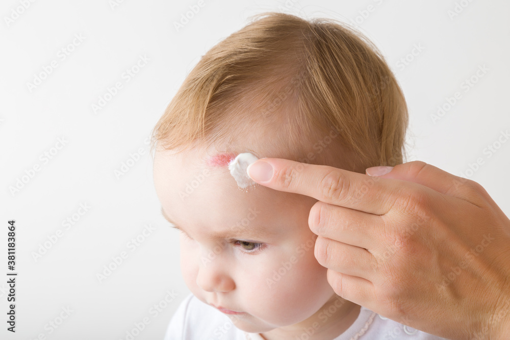 Female finger applying medical ointment on baby abrasion skin. Mother giving first aid. Infant head closeup isolated on light gray background. Female finger applying medical ointment on baby abrasion skin. Mother giving first aid. Infant head closeup isolated on light gray background.