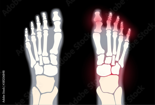 Arthritis foot concept