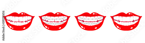 Vector cartoon set of smiling mouths with stages of teeth alignment using orthodontic metal braces on a white background