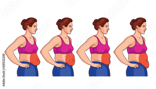Color vector illustration isolated on white background. Four types of belly in women. Overweight woman side view. Problem areas in women on the stomach