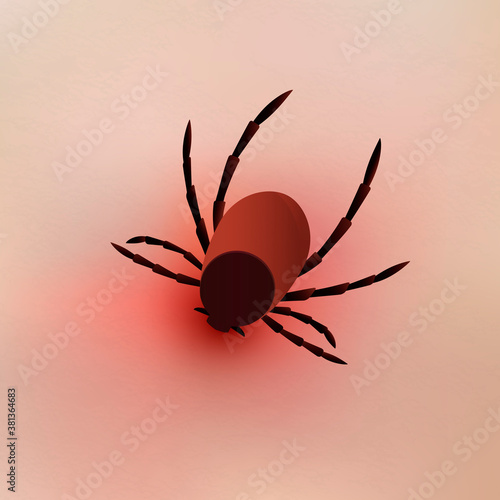 Tick bite on human scin. Realistic vector illustration.
