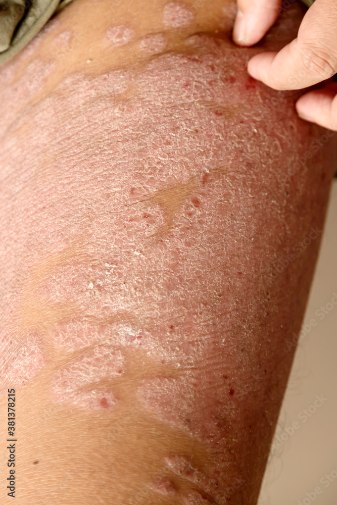 Diseases caused by abnormalities of the lymph. Psoriasis is a skin disease. Diseases caused by abnormalities of the lymph. Psoriasis is a skin disease.