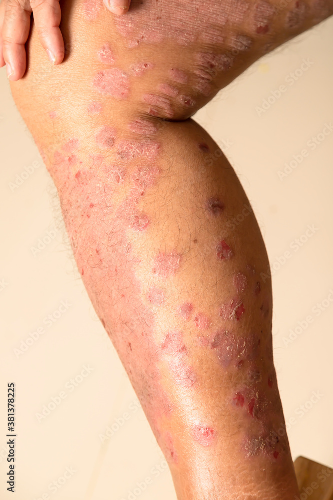 Fototapeta premium Diseases caused by abnormalities of the lymph. Psoriasis is a skin disease.