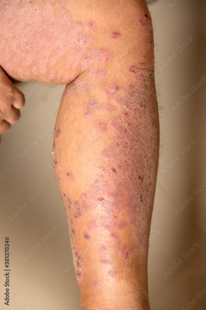 Fototapeta premium Diseases caused by abnormalities of the lymph. Psoriasis is a skin disease.