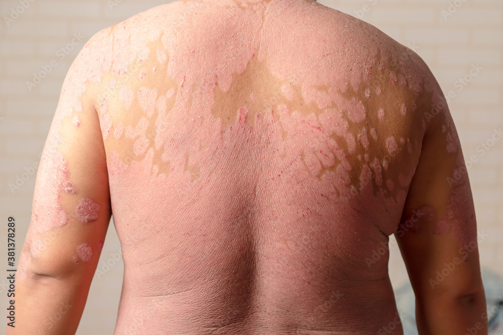Diseases caused by abnormalities of the lymph. Psoriasis is a skin disease. Diseases caused by abnormalities of the lymph. Psoriasis is a skin disease.