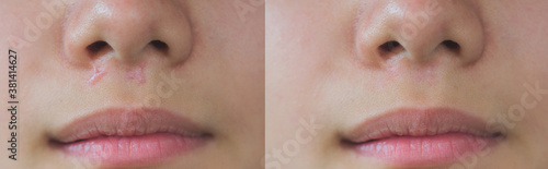 image compare keloid scars on skin face before and after laser treatments photo