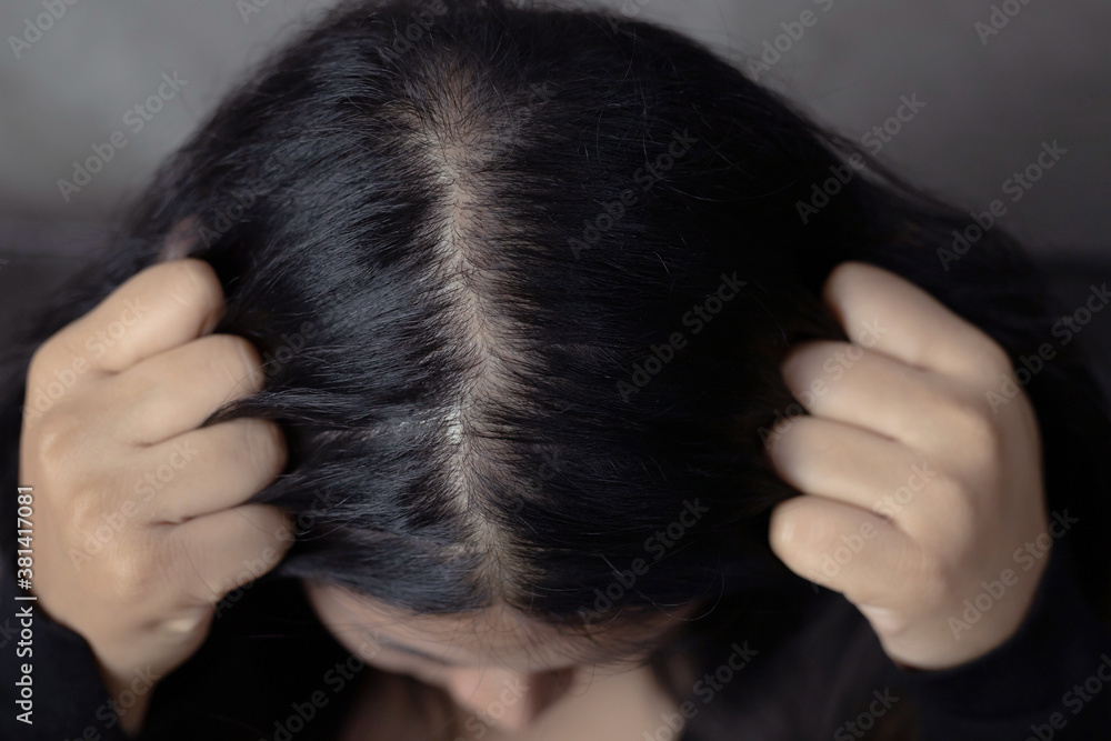 Naklejka premium A woman has hair problems, she has hair loss.