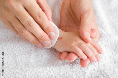 Принти на полотні Young woman hand using white cotton pad and cleaning abrasion on baby hand skin after accident