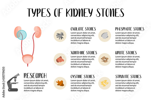 Types of kidneys stones. Oxalate, phosphate, xanthine, urate, cystine, struvite stones. Urolithiasis disease. Kidney and bladder disease. Vector flat illustration. Perfect for flyer, medical brochure