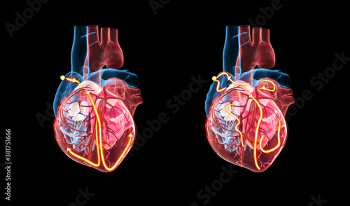 Photos Anatomy of the human heart, the yellow lines demonstrating the electrical (conduction) system of the heart