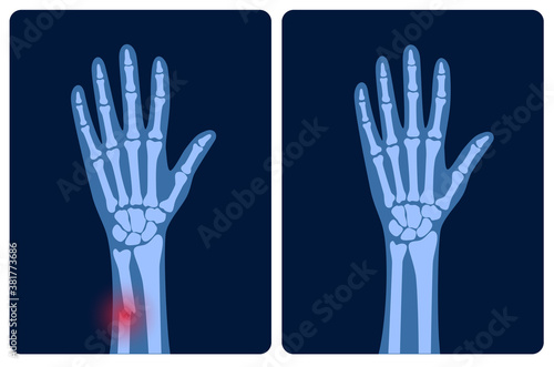 Fracture x ray concept