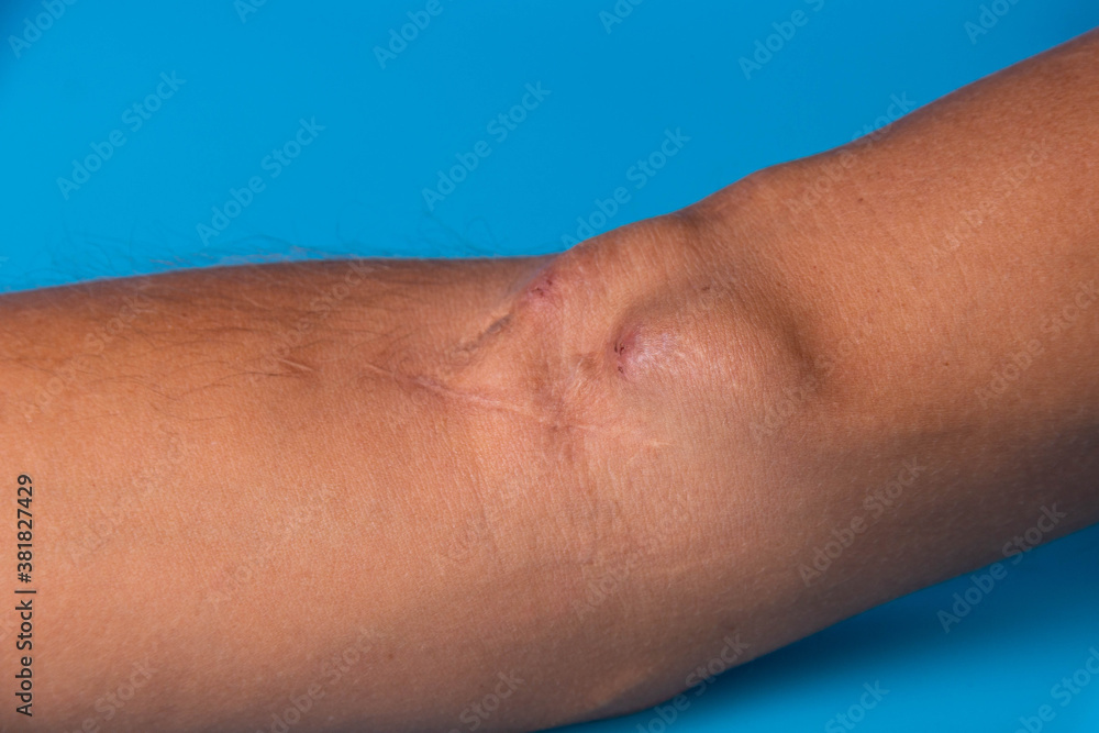 Fistula on the arm as a result of an operation for hemodialysis with