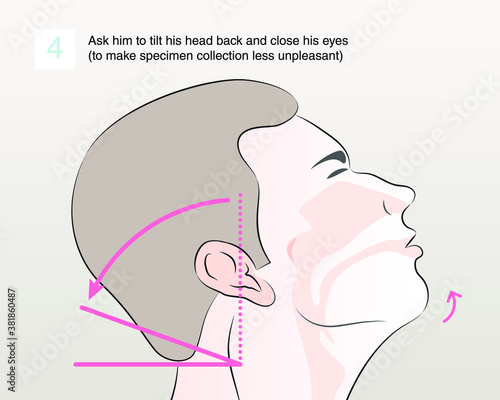Tilt patient’s head back 70 degrees. Ask him to tilt his head back and close his eyes (to make specimen collection less unpleasant). step 4