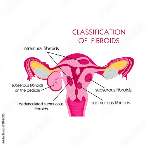 Fibroids, great design for any purposes. Cartoon flat vector illustration. Isolated vector.