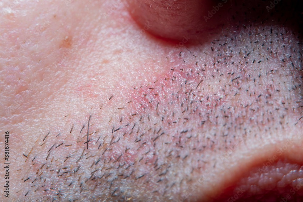 Men's skin with the remains of a shaved beard in soft focus with strong magnification under the microscope. Irritation on the skin after shaving uneven sections, damage to the skin and pores. Men's skin with the remains of a shaved beard in soft focus with strong magnification under the microscope. Irritation on the skin after shaving uneven sections, damage to the skin and pores.
