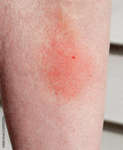 Obraz na plátně Wasp sting and surrounding irritation on shin