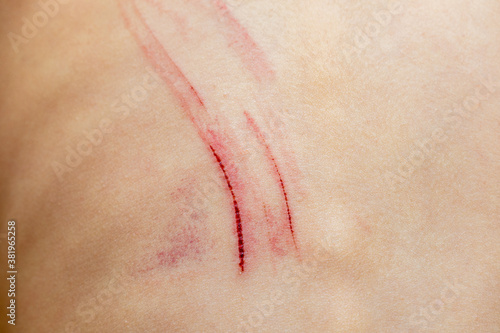 Wounds scratches on the back of a small child close up