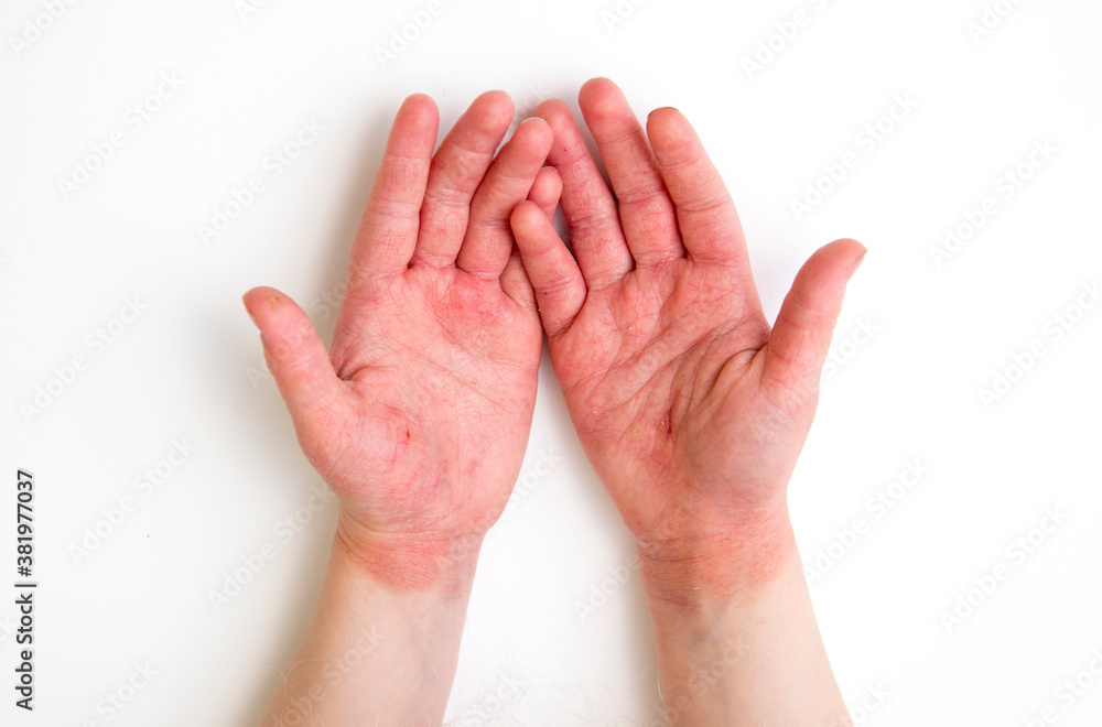 4 year old child red swollen cracked atopic dermatitis hands caused by lot of hand washing and hand sanitizing during covid-19 pandemic period in 2020. 4 year old child red swollen cracked atopic dermatitis hands caused by lot of hand washing and hand sanitizing during covid-19 pandemic period in 2020.