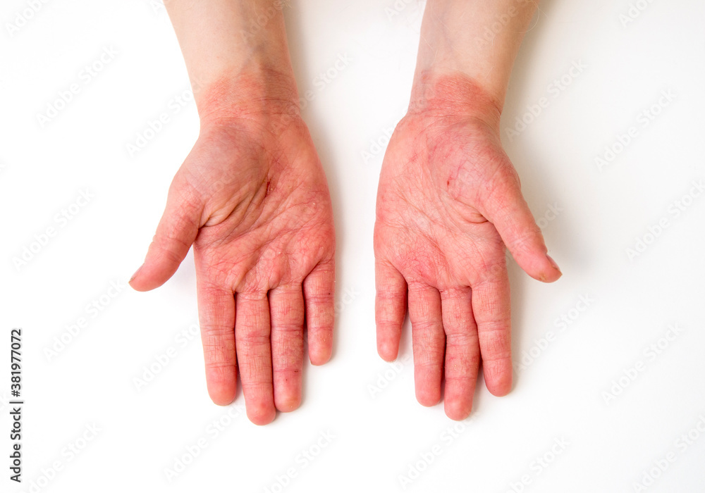 4 year old child red swollen cracked atopic dermatitis hands caused by lot of hand washing and hand sanitizing during covid-19 pandemic period in 2020. 4 year old child red swollen cracked atopic dermatitis hands caused by lot of hand washing and hand sanitizing during covid-19 pandemic period in 2020.