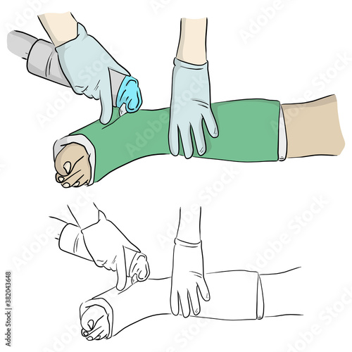 close-up hand cutting plaster cast at leg and foot patient to immobilize after fracture injury vector illustration sketch doodle hand drawn with black lines isolated on white background